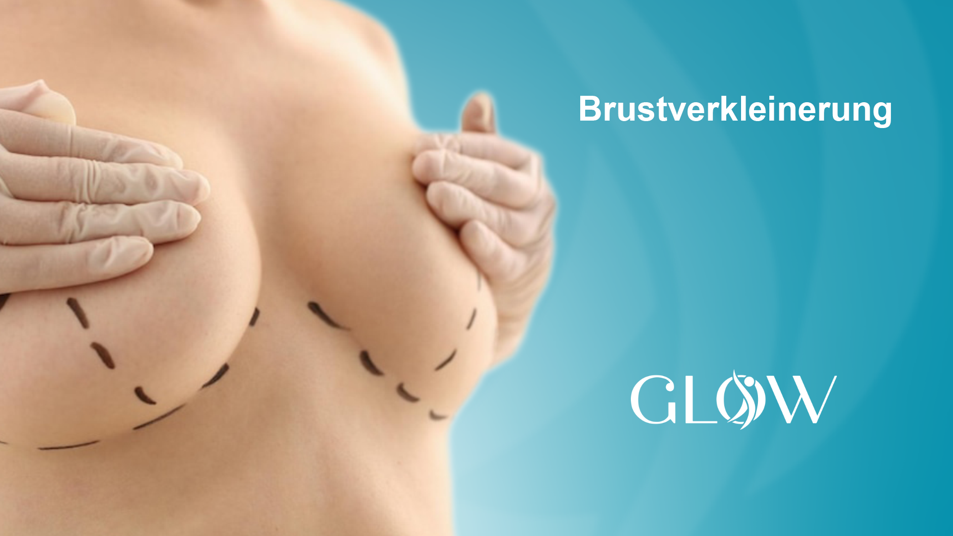 Brustverkleinerung