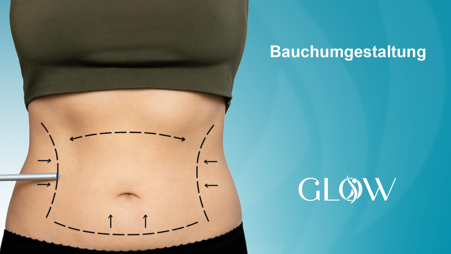 Bauchumgestaltung